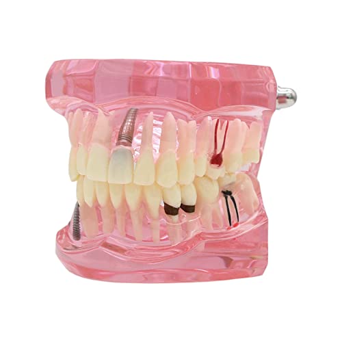 Book Cover Dentalmall Teeth Model Teeth Typodonts Dental Implant Study Analysis Demonstration Teeth Model #2001 with Restoration Pink